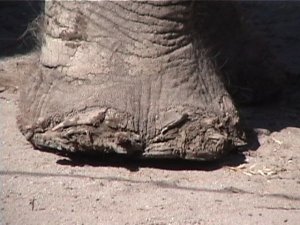 elephant foot osteomyilitis